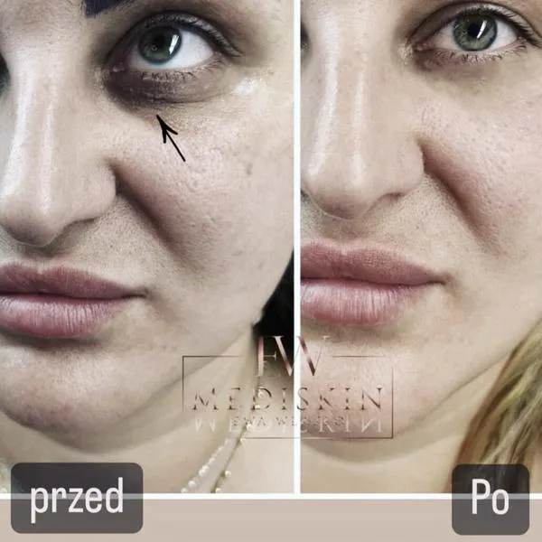 Usuwanie cienia w Photoshopie